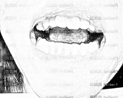 太原华美整形美容医院白丽鹏超声波洁牙案例图片最新分享_超声波洁牙，让自己的牙齿更健康。