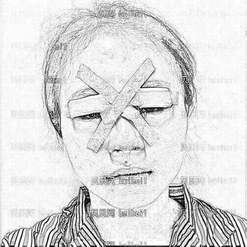 天津河东丽人医院李庸国切开双眼皮介绍片较新分享_眼睛恢复后更漂亮了!