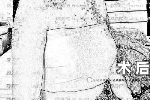 天津华夏医院韩式整形美容科袁超英隆胸案例图片最新分享_真人自述恢复日记公开