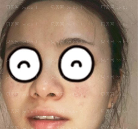 天津解放军四六四医院整形美容科付伟娜激光祛斑介绍片较新分享_恢复果或许你也想不到!