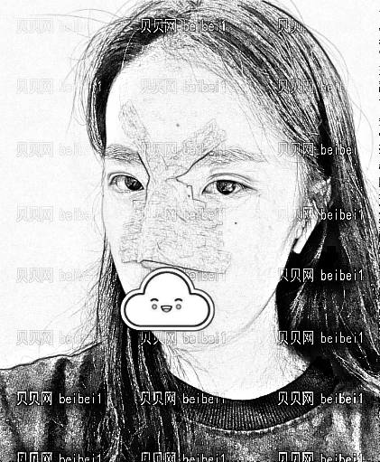 天津乐园医院医学美容整形中心欧阳武医生假体隆鼻介绍片较新分享_术后果敲自然哦!