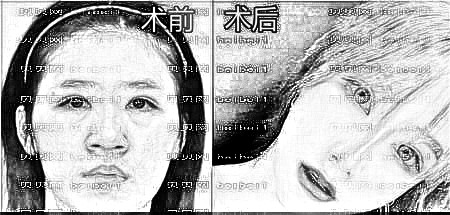 天津欧菲整形美容医院梁海元鼻部手术介绍片较新分享_不看后悔系列(果就是这么好的啦)!