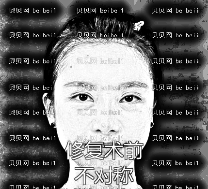 天津欧菲整形美容医院陈育哲双眼皮修复介绍片较新分享_恢复果展示！