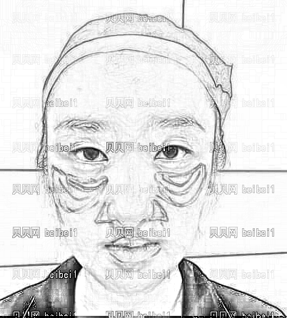 天津欧菲整形美容医院王世宏自体脂肪填充泪沟介绍片较新分享_变美就是这么简单！