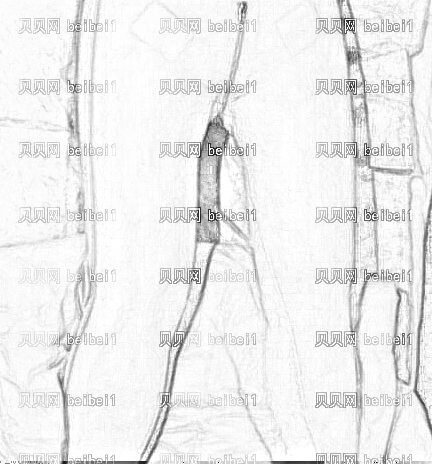 天津欧菲整形美容医院王世宏吸脂瘦腿介绍片较新分享_吸脂咋样/看看我的恢复过程吧!