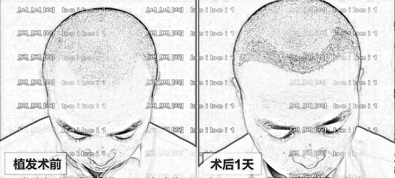 成都碧莲盛植发怎么样?哪个医生技术好