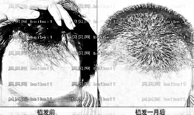 成都恒美植发怎么样？哪个医生技术好