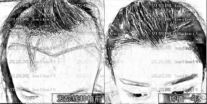 济南熙朵植发怎么样?哪个医生技术好