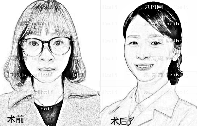 青岛新视界眼科医院怎么样?靠谱吗?,近视手术曝光!
