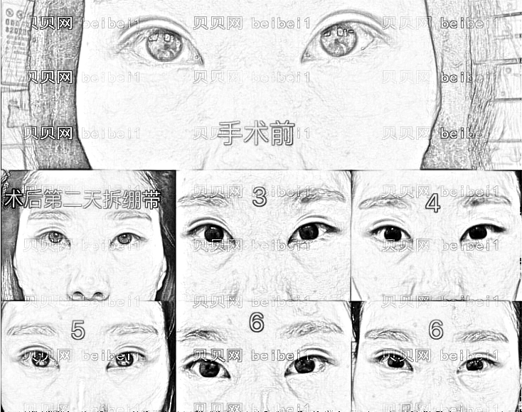 内切去眼袋没问题吗?手术恢复过程,内切去眼袋术后注意事项有哪些