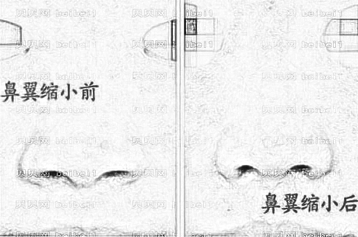 鼻翼缩小的方法有哪几种?鼻翼缩小手术会留疤吗?