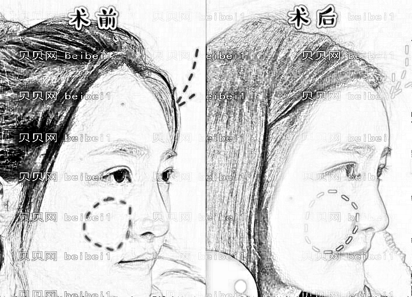常州施尔美自体脂肪填充多少钱?哪个医生技术?附介绍