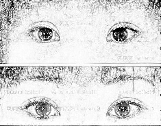 双眼皮手术开眼角和不开眼角的区别大吗？割双眼皮为什么要开眼角