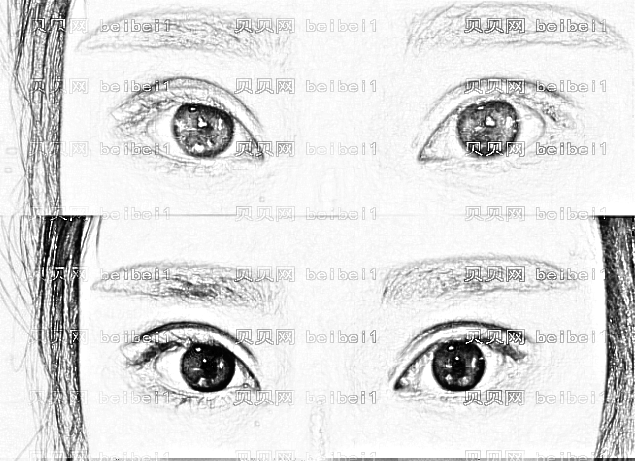 割双眼皮失败多久可以做眼修复手术?双眼皮修复手术CG高吗?