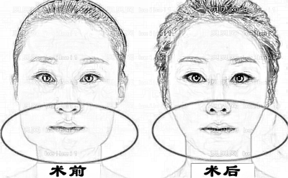什么情况下适合做下颌角磨骨?下颌角磨骨的步骤有哪些?