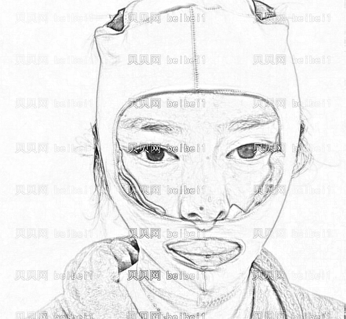 颧骨内推术后需要戴头套吗?颧骨内推术后要戴多久头套?