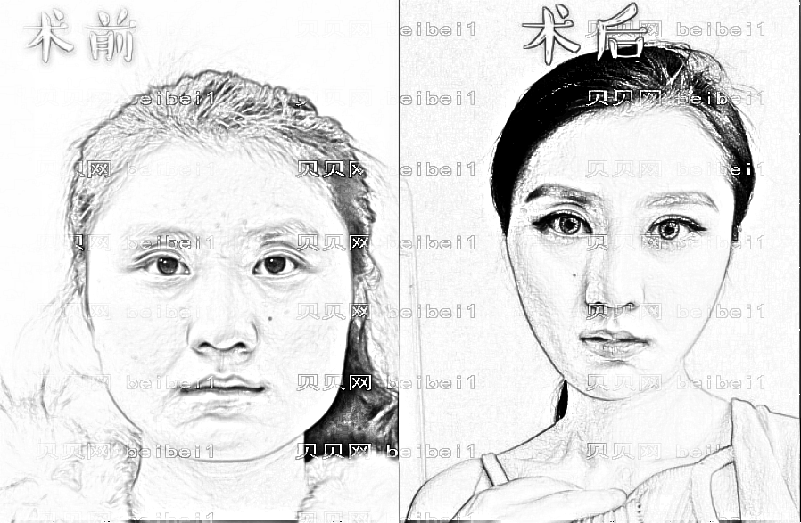 颧骨内推术后需要戴头套吗?颧骨内推术后要戴多久头套?
