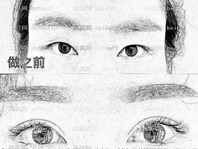 武汉壹加壹整形医院双眼皮做得怎么样?附,双眼皮+介绍