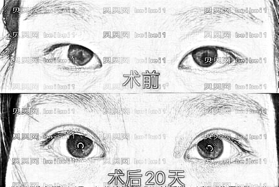 宜昌奥莱整形美容医院正规吗?内附医生排名+新版双眼皮