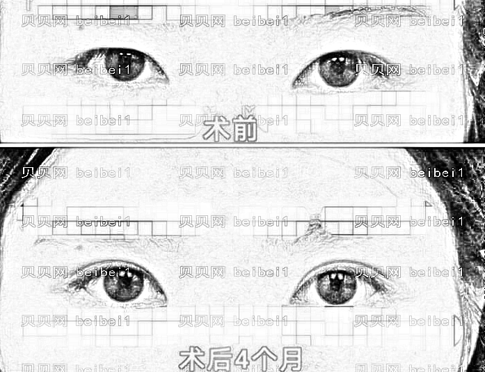 邯郸做双眼皮哪家医院好?邯郸双眼皮医生排名名单&附介绍