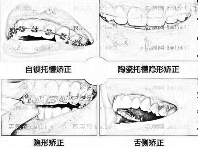 牙齿矫正需要多长时间?牙齿矫正器的种类有哪些?