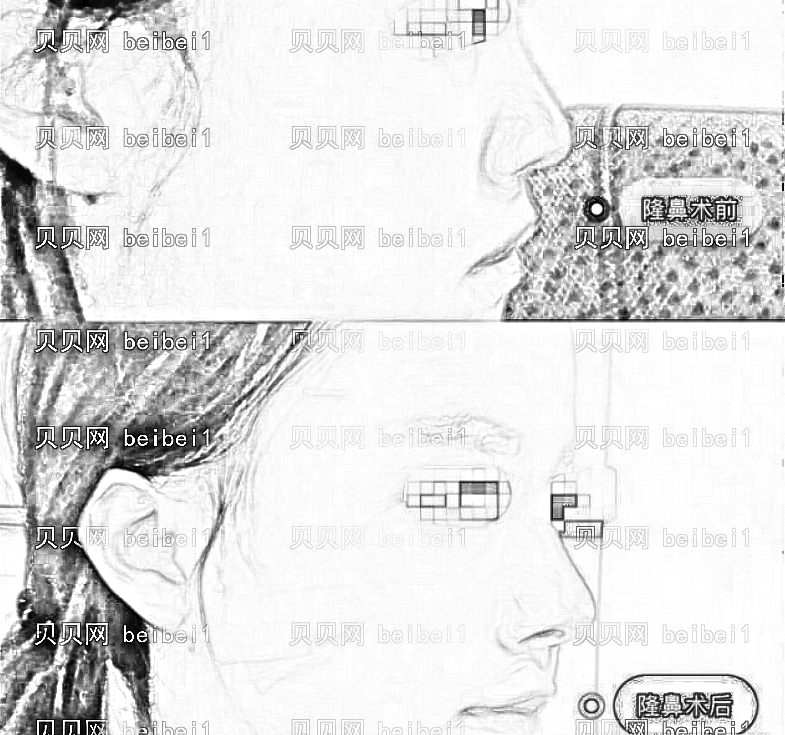 公布佛山隆鼻医生排名前十榜单|附介绍分享+隆鼻