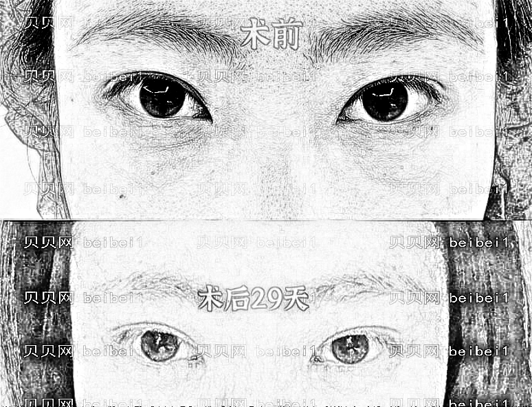 南京美贝尔整形医院做眼袋怎么样？南京美贝尔去眼袋多少钱？
