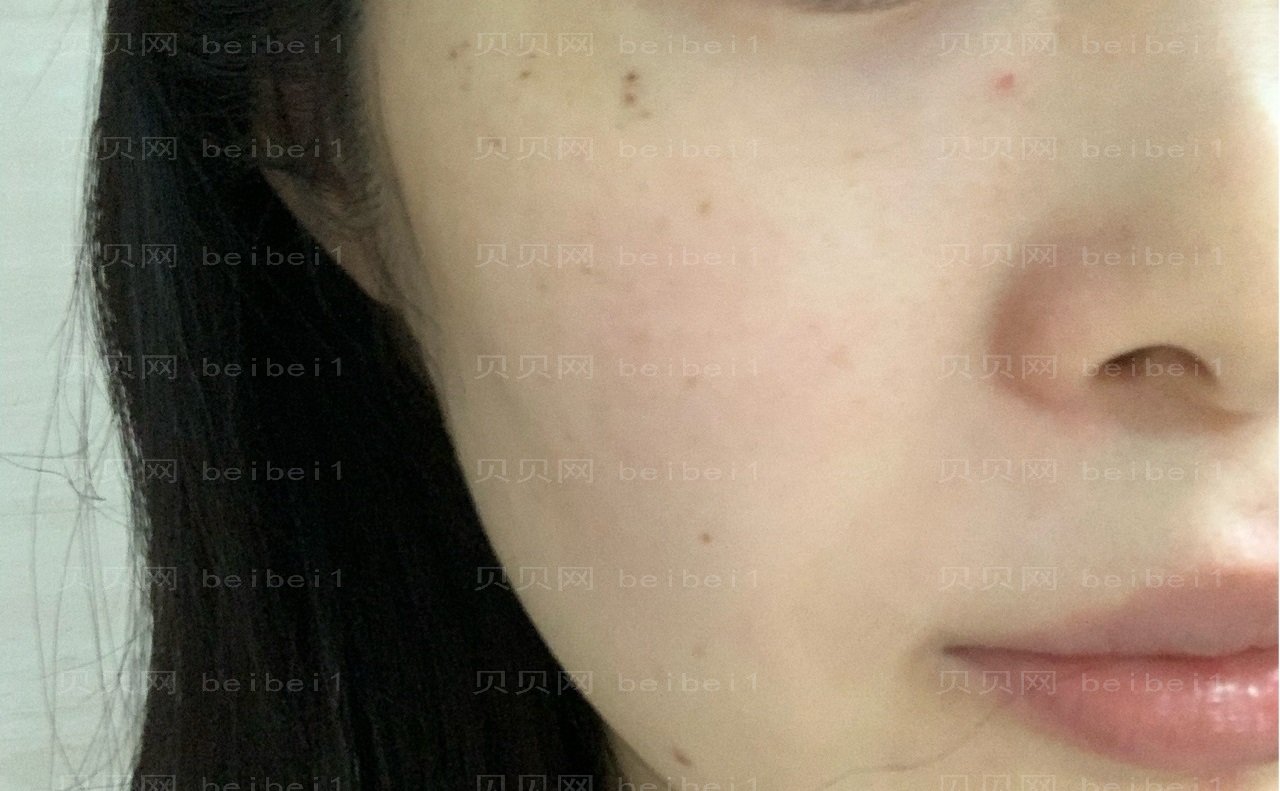烟台做光子嫩肤哪家医院靠谱？烟台做光子嫩肤价格多少钱？