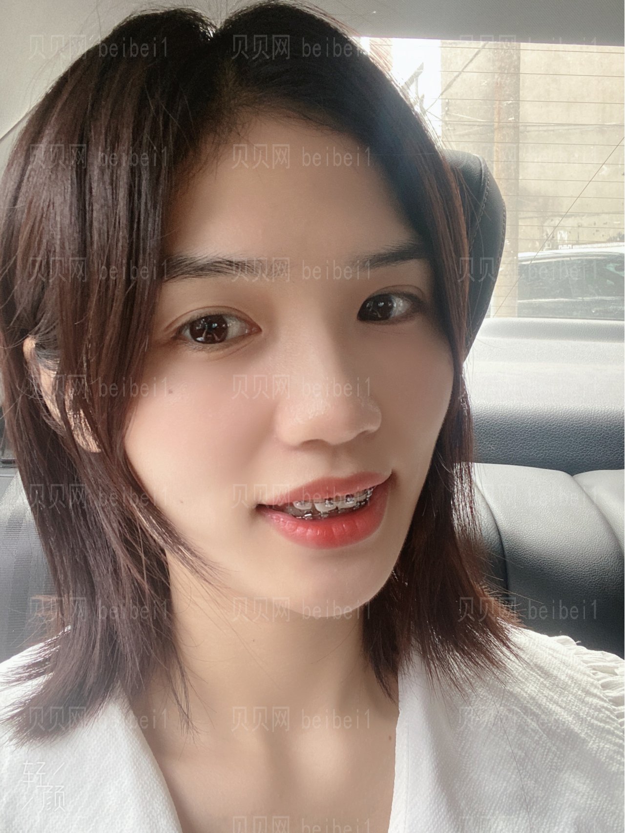东莞恒好口腔金属牙齿矫正价格多少钱?恒好口腔正畸介绍分享