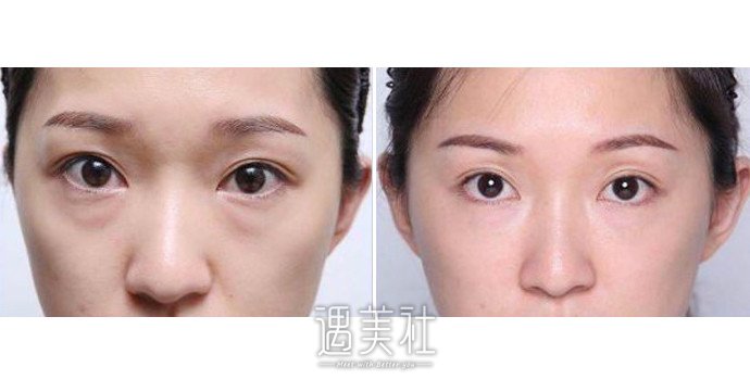 玻尿酸丰泪沟价格