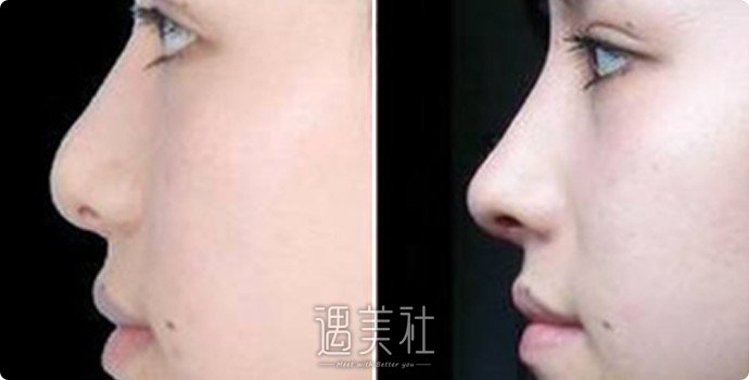 玻尿酸隆鼻价格