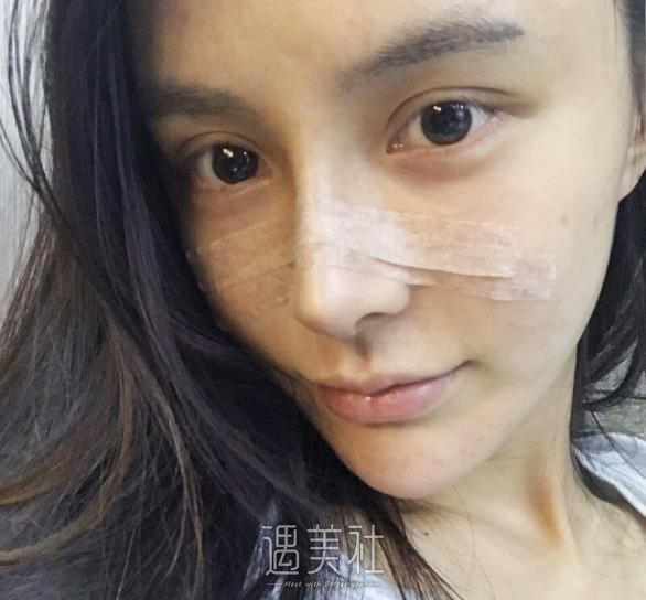 杭州美联致美医疗美容——硅胶隆鼻