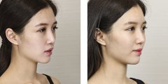 玻尿酸丰苹果肌价格
