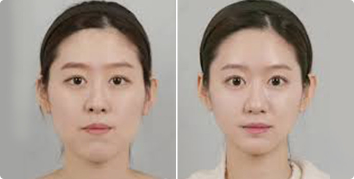 颧骨颧弓整形术的价格是多少