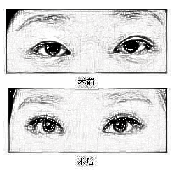 双眼皮手术风险大吗?术后需要注意什么呢?