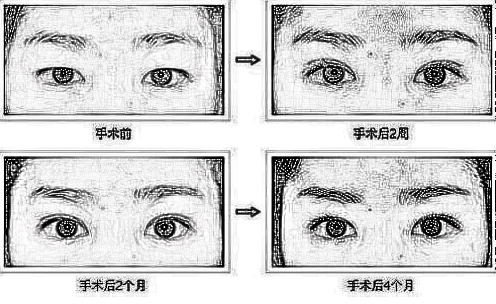 双眼皮手术风险大吗?术后需要注意什么呢?