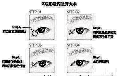 眼部手术开眼角具体优势是什么?