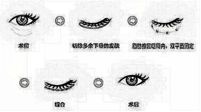 眼部手术你还认为只是切开双眼皮吗?