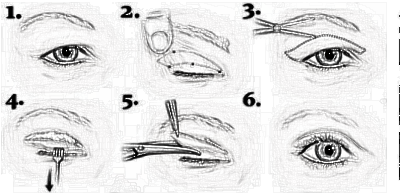 眼部手术你还认为只是切开双眼皮吗?