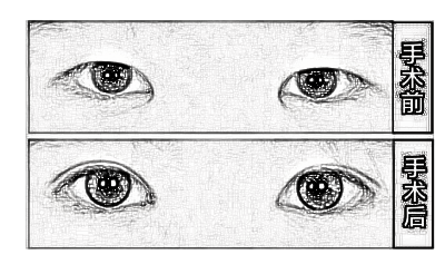 开眼角手术怎么样?多久能恢复自然?
