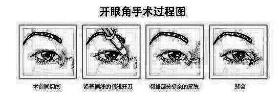 开眼角会不会出现后遗症?