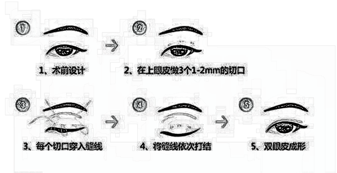 埋线双眼皮的适合人群以及方法你知道吗?
