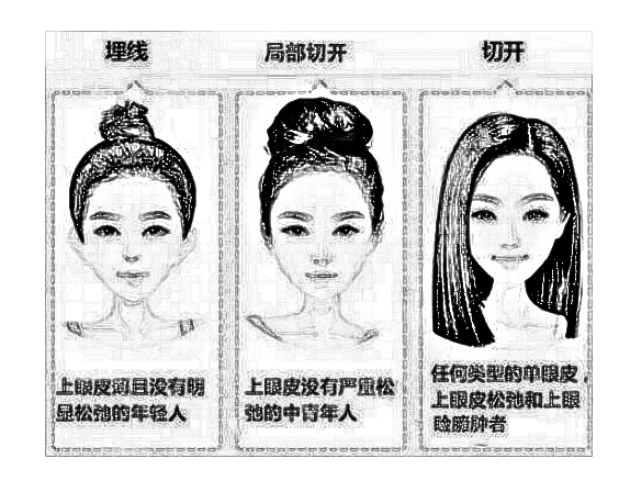 埋线双眼皮的适合人群以及方法你知道吗?