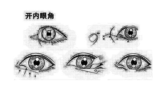 眼角开大了怎么办?可以修复吗?