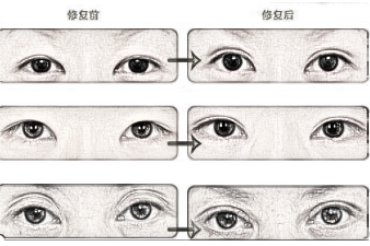 为什么北京的双眼皮修复价格要贵一些？