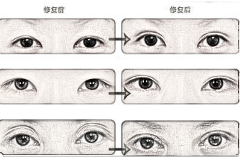 为什么北京的双眼皮修复价格要贵一些?