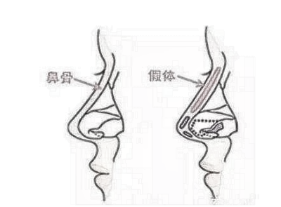 隆鼻硅胶和膨体有什么区别?如何选择?