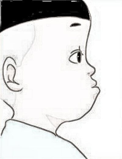 隆鼻术真能改良凸嘴吗?