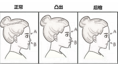 隆鼻术真能改良凸嘴吗?