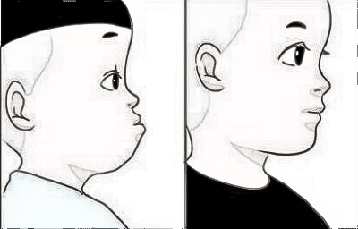 隆鼻术真能改良凸嘴吗?